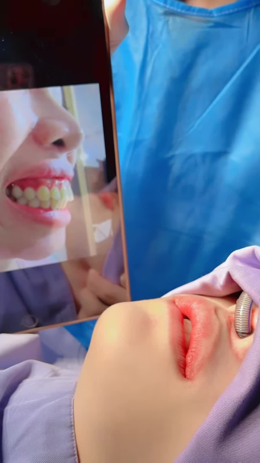 Hình ảnh thực tế sau khi sử dụng công nghệ Chỉnh hàm 6D tại Kangnam
